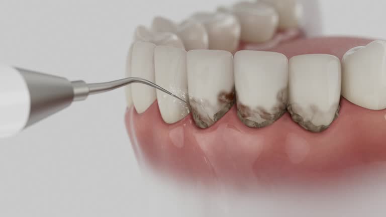 Trusted Wisdom Tooth Removal service in Craig, CO - Dentist Open Now